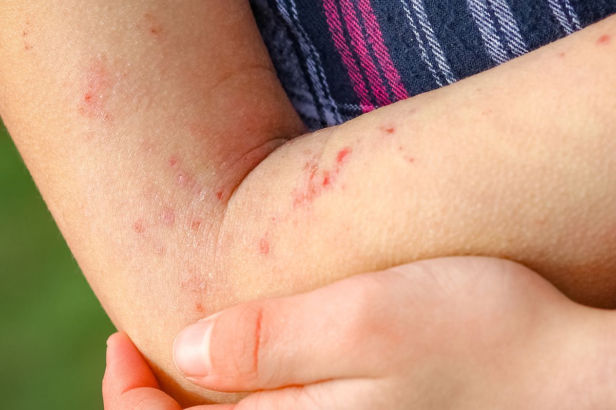 Resiko Alergi Obat Kuat Alami